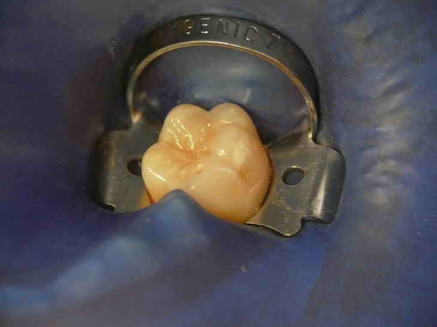 La digue dentaire - Dr Pascal Belzgaou - Hauts-de-Seine