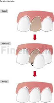 facettes dentaire dentiste 92