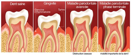 maladie parodontale